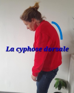 cyphose dorsale