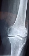 arthrose genou